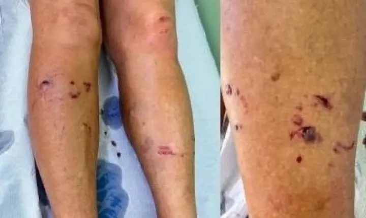 Raposa ataca mulher durante caminhada na zona rural de Cruz das Almas; terceiro caso em 8 dias